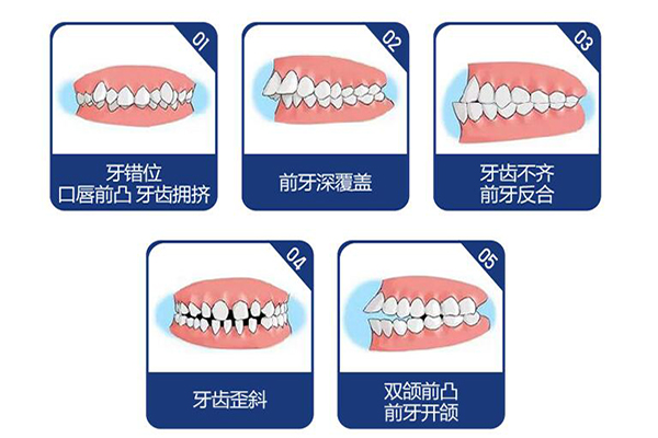 牙齿矫正影响颜值