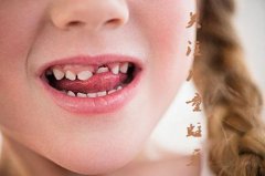 合肥儿童补牙多少钱？