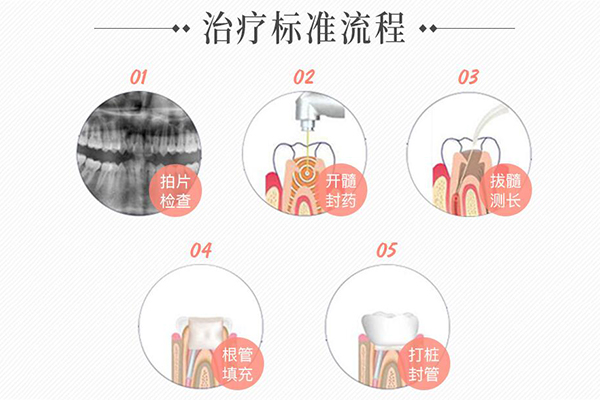 根管的治疗价格