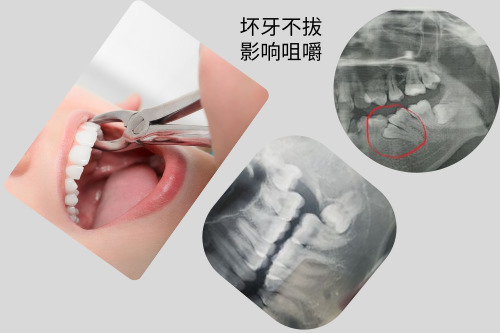 合肥拔牙可以用医保吗—不用医保也能省