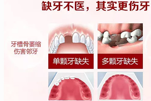 合肥植牙去哪好