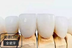 合肥全瓷牙价格是多少-真比烤瓷牙贵几倍吗？