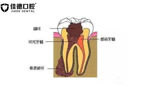 合肥根管的治疗可以报销吗