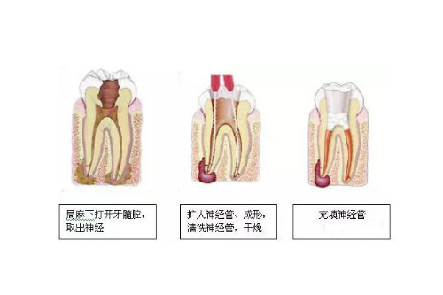 合肥根管的治疗可以报销吗