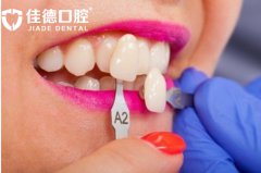 合肥瓷贴面多少钱一颗-千金真能换美齿吗？