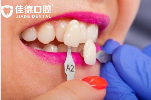 合肥瓷贴面多少钱一颗