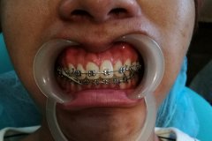 合肥矫正牙套多少钱_选哪种牙套好？