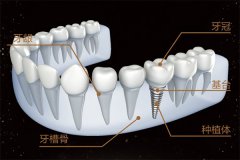 合肥牙齿种植多少钱一颗_健康牙齿种出来？