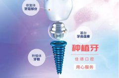 合肥种植牙价格-你不知道的种牙价格真相