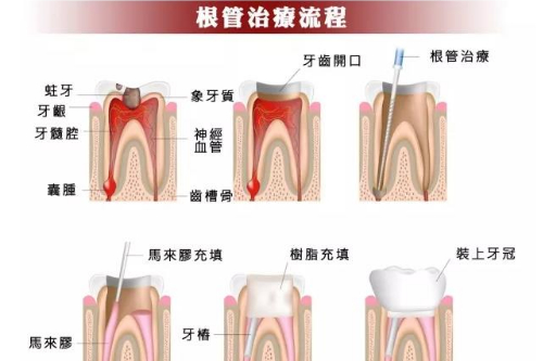 合肥根管的治疗牙齿多少钱