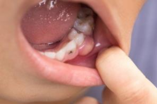 合肥的口腔牙科补牙价格表