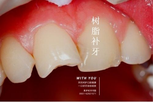 补牙