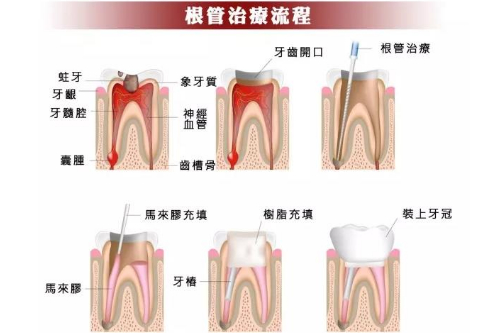 合肥根管的治疗牙齿多少钱