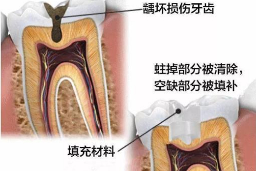 合肥补牙洞多少钱