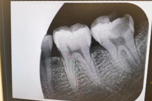 合肥根管的治疗牙齿多少钱