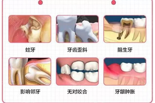 合肥拔牙收费标准