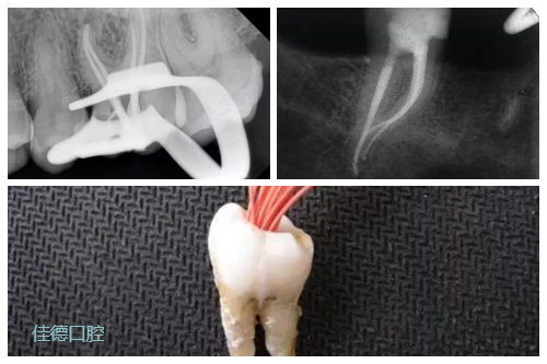根管的治疗