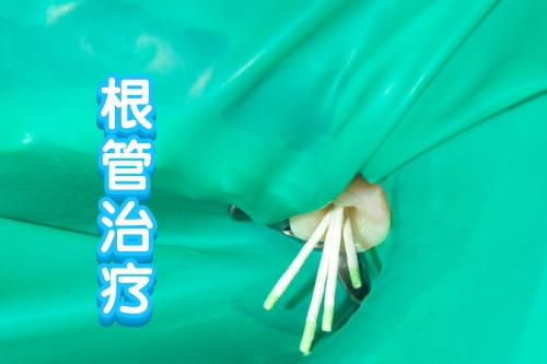 合肥根管治疗牙齿多少钱
