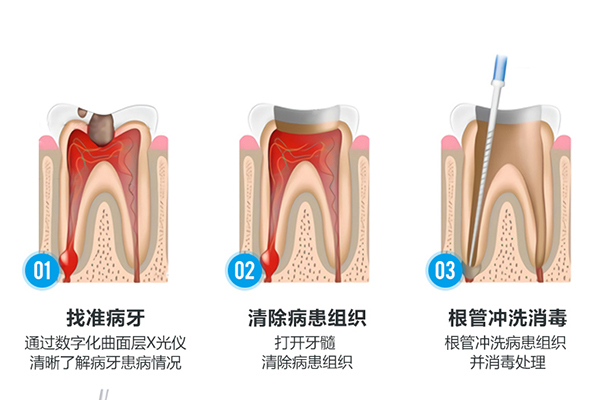 根管的治疗