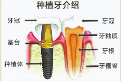 合肥种植牙大概多少钱/价格表