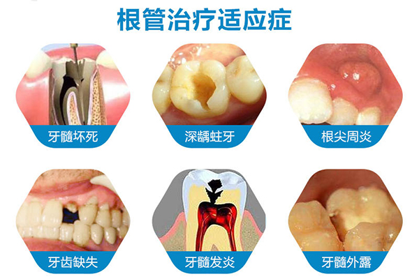 根管的治疗