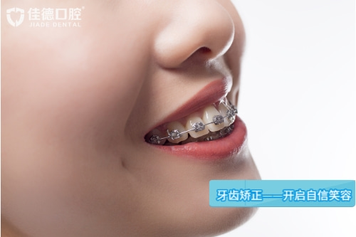 合肥牙齿矫正费用一览表