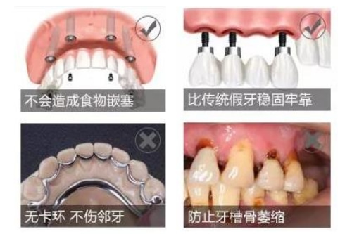 合肥种植牙价格表