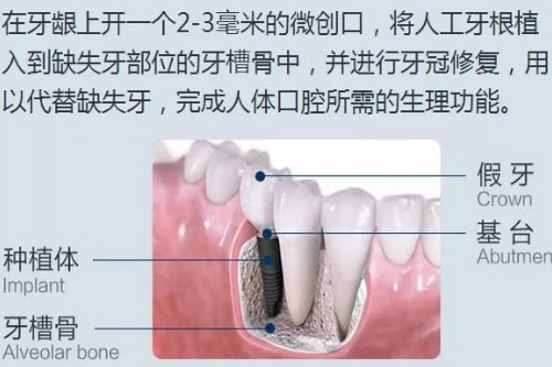 合肥市种植牙哪家比较好