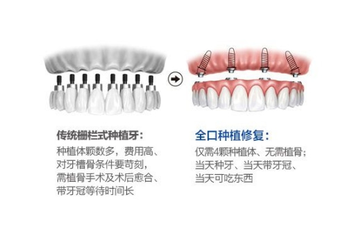 合肥市种一颗牙一般要多少钱