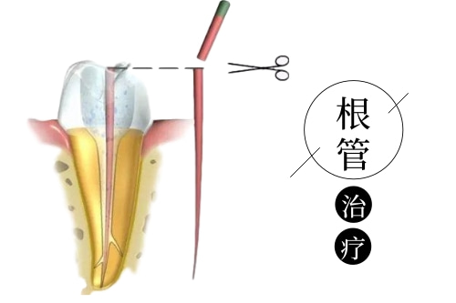 合肥根管治疗多少钱