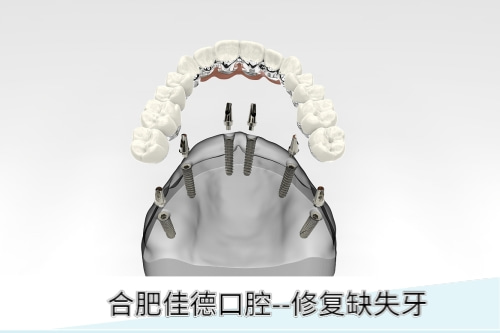 合肥种牙费用是多少