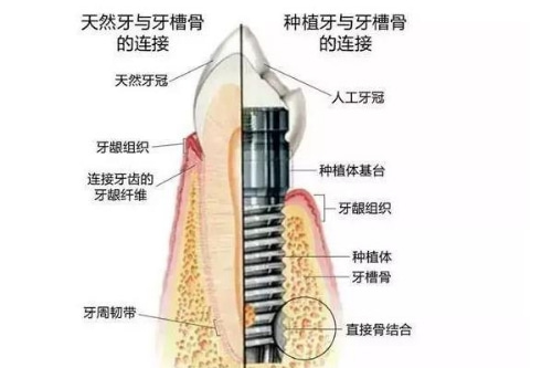 合肥种牙费用是多少
