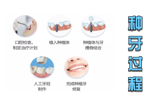合肥的口腔牙科种牙费用