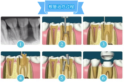 合肥根管治疗、佳德口腔根管收费