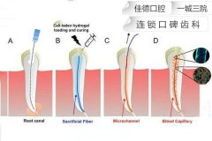 合肥根管的治疗多少钱-费用因人而异