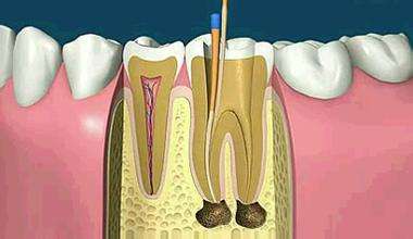 合肥根管的治疗多少钱-牙疼别乱忍