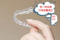 合肥隐形矫正多少钱-给力低价实惠之选