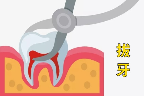 合肥拔牙多少钱一颗呢?