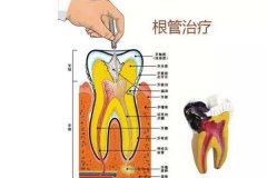 合肥牙齿做根管的治疗多少钱?--根管的治疗费用是这