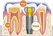 合肥种植牙