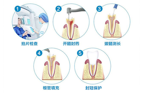 根管的治疗