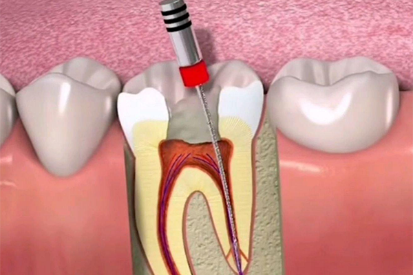 根管的治疗