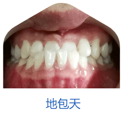 牙齿缝隙大