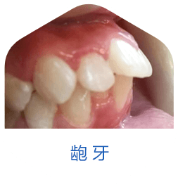 龅牙