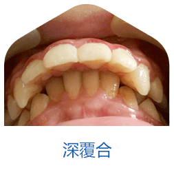 深覆合